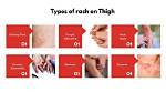 Understanding and Managing Inner Thigh Rash: a Comprehensive Guide